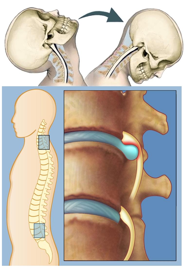 교통사고 변호사, 목 허리 디스크 부상,la 교통사고 변호사, 교통사고 변호사 엘에이
