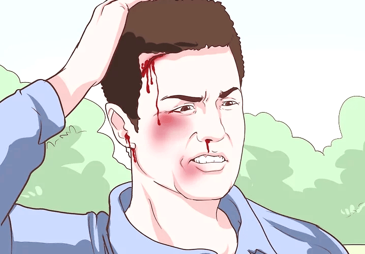 머리부상 교통사고 변호사, 교통사고 변호사,la 교통사고 변호사, 교통사고 변호사 엘에이